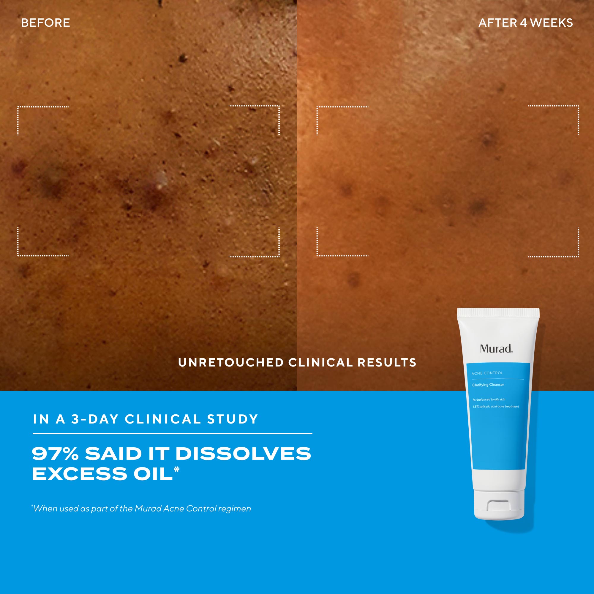Murad Acne Control Clarifying Cleanser - Mirrors Beauty